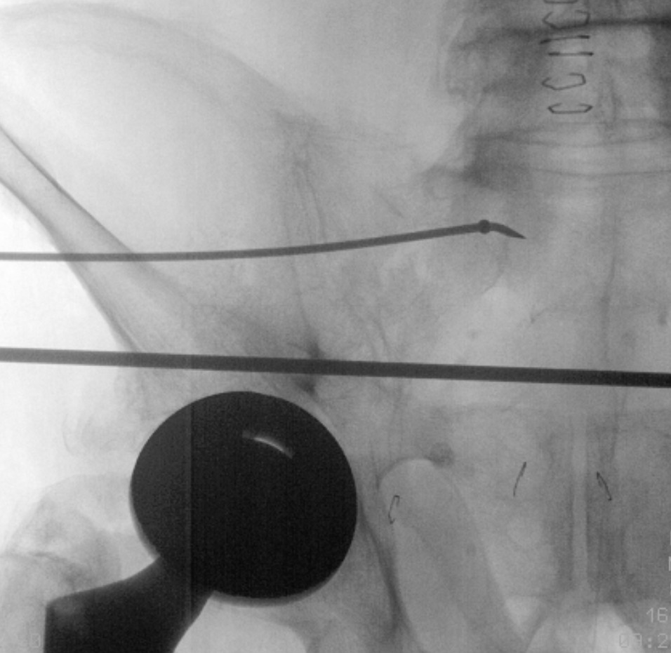X-ray of a spine with a needle Description automatically generated