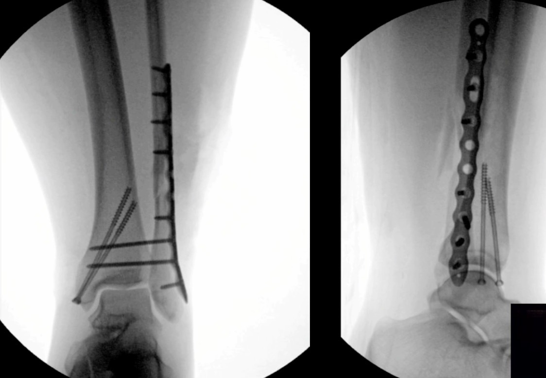 X-ray of a broken leg AI-generated content may be incorrect.