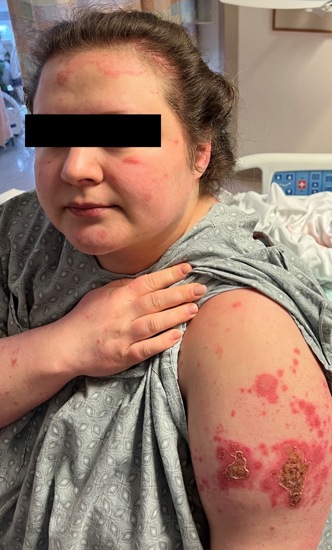 Subacute Cutaneous Lupus Face
