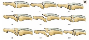 Mallet fractures: a prospective comparison of treatment outcomes ...