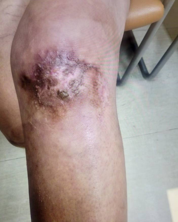 A close-up of a bruise on a person's leg Description automatically generated