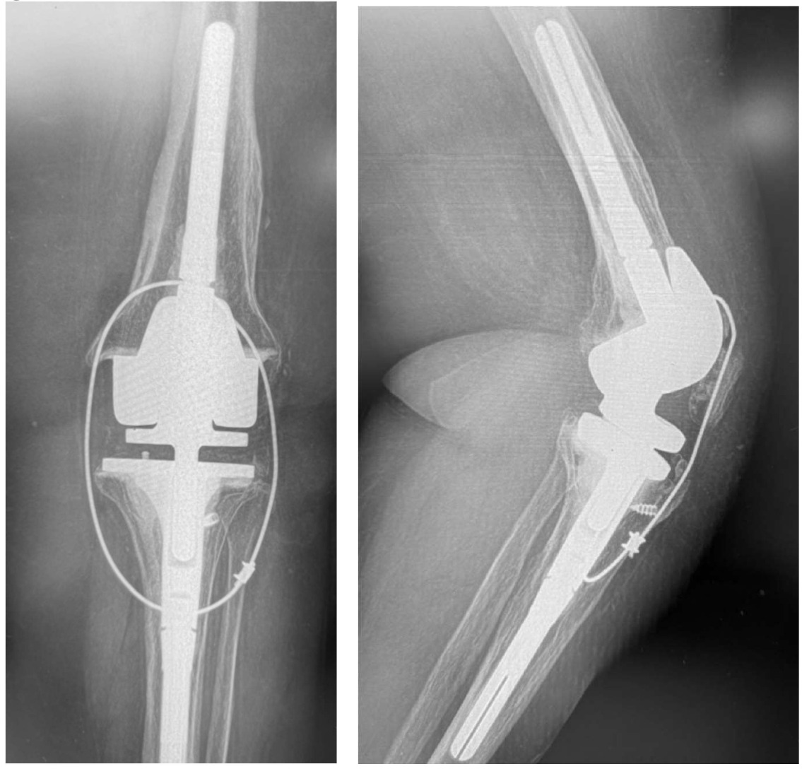 X-ray of a bone AI-generated content may be incorrect.