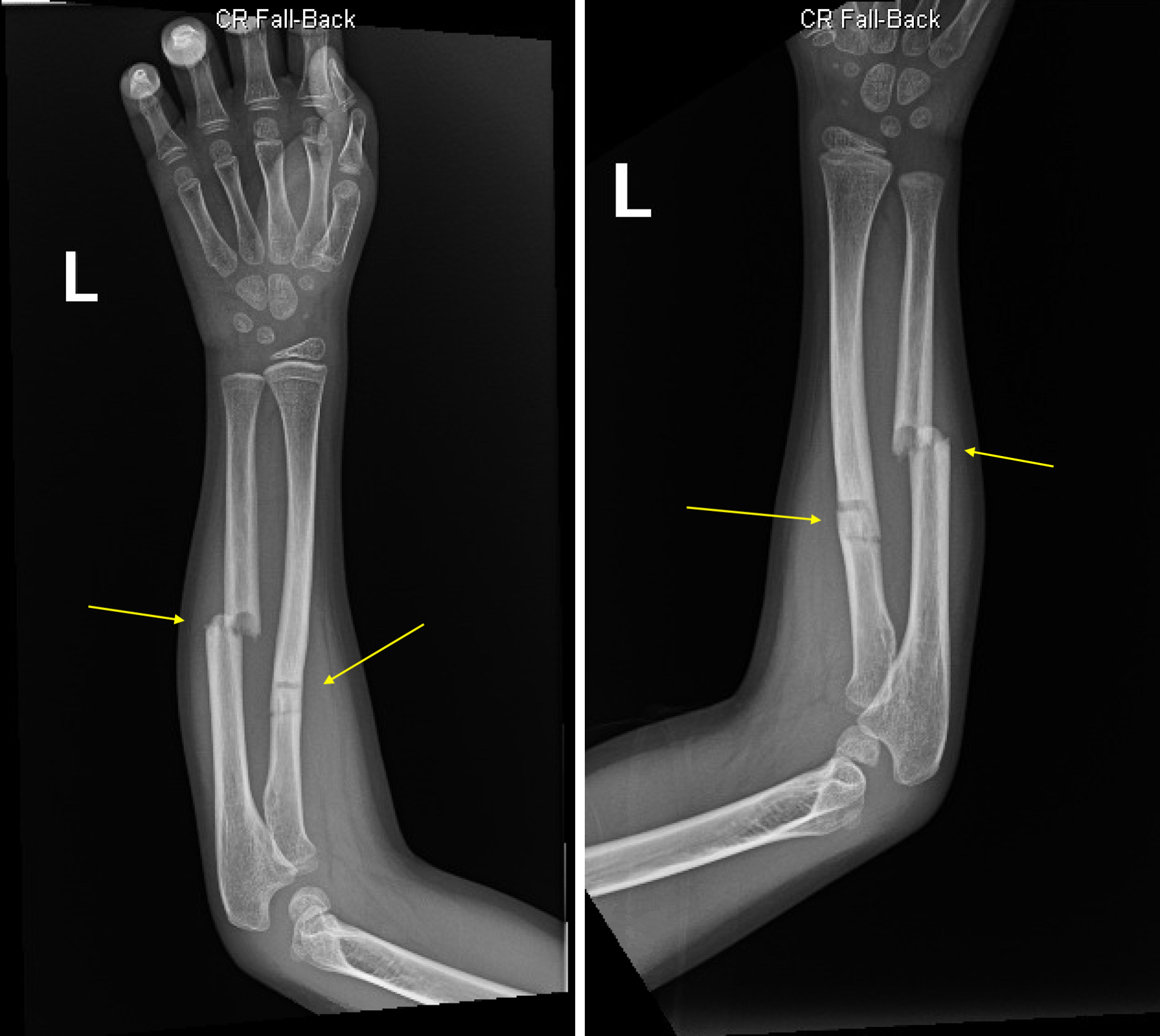 Greenstick Fractures of the mid- Radial and Ulnar Diaphysis with Volar ...