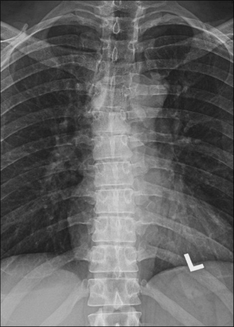 Thoracic-spine-AP-view.-T4-vertebral-body-interpreted-as-normal.