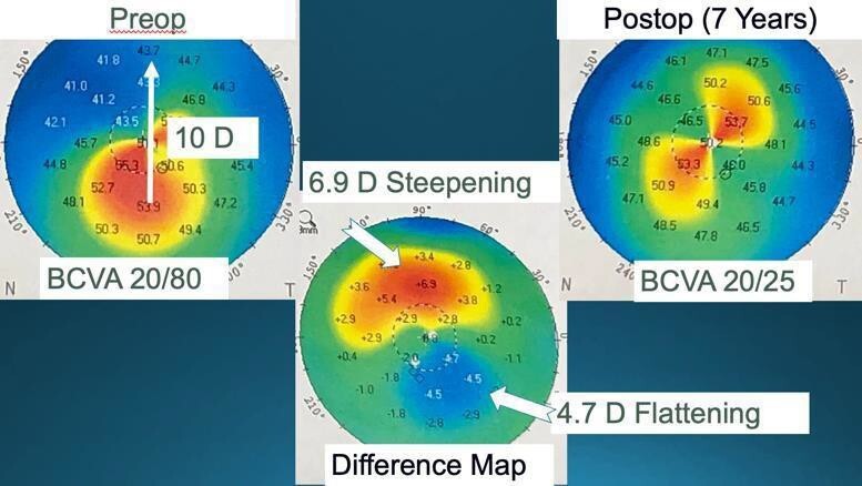 Refractive Correction Refractive Surgery Overview | Published in CRO (Clinical & Refractive ...