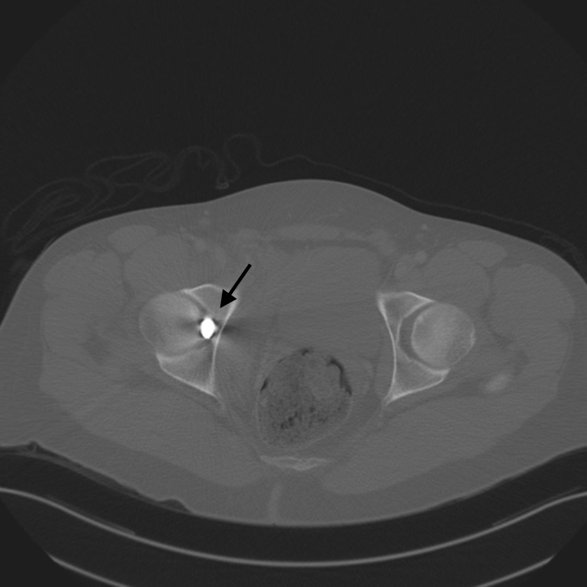 An x-ray of a pelvis Description automatically generated