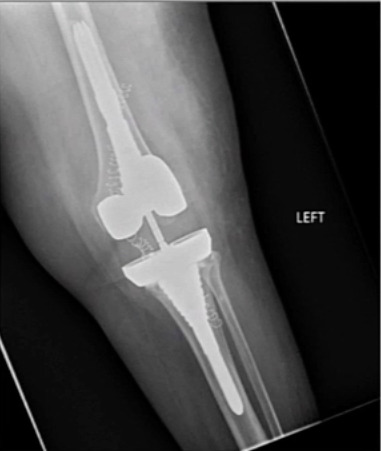 X-ray of a leg with a joint AI-generated content may be incorrect.