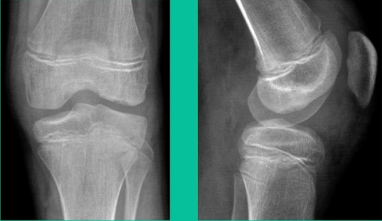 X-ray of a knee joint AI-generated content may be incorrect.
