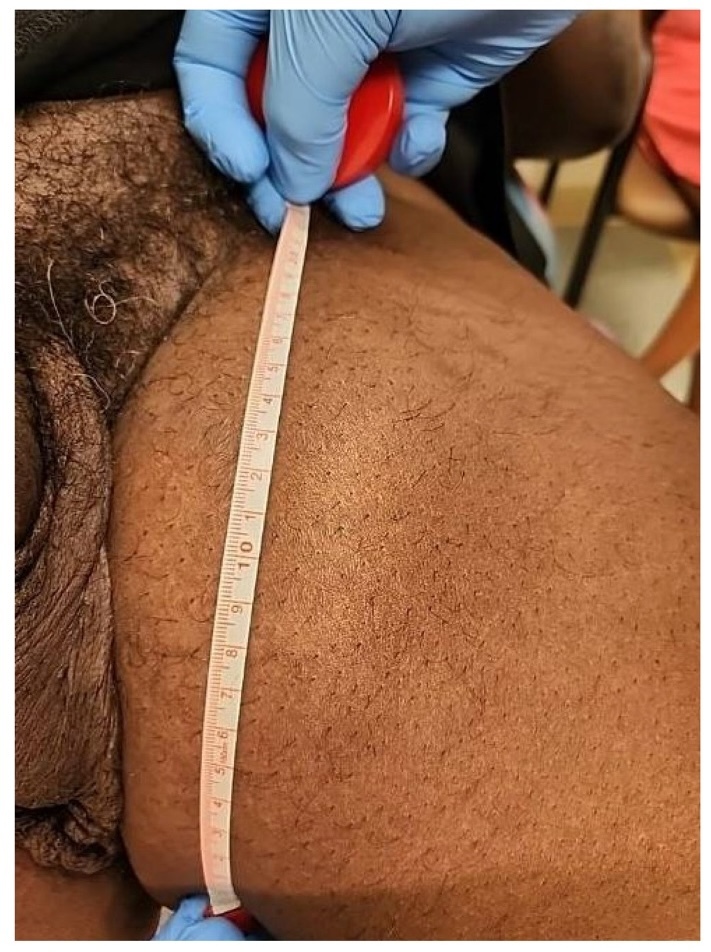 Extra-Abdominal Leiomyosarcoma: A Case Report | Published in 