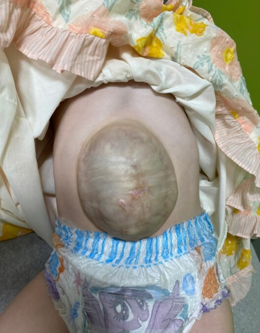A baby's stomach with a large breast Description automatically generated with medium confidence