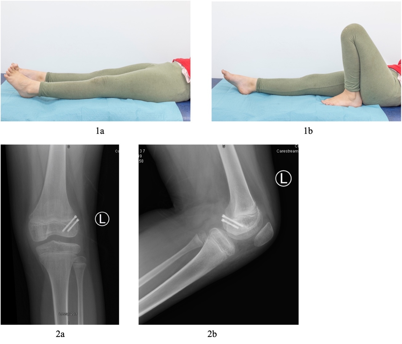 Afbeelding met röntgenfilm, joint, Medische beeldbewerking, radiologie Door AI gegenereerde inhoud is mogelijk onjuist.
