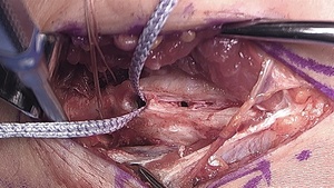 Ulnar Collateral Ligament Hybrid Reconstruction Surgery ...
