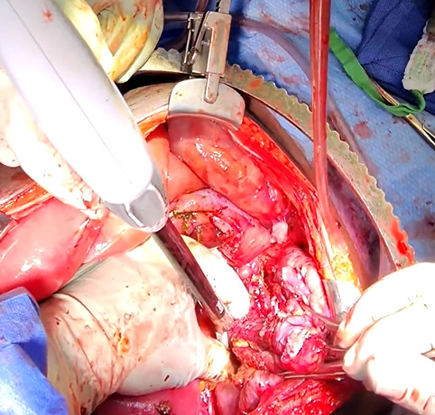 A person performing surgery in a heart AI-generated content may be incorrect.