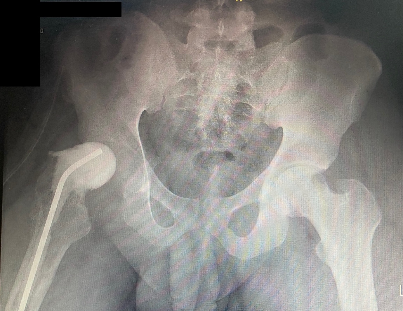 X-ray of a person's body AI-generated content may be incorrect.