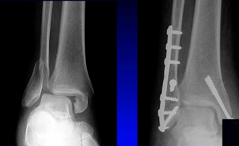 X-ray of a broken leg AI-generated content may be incorrect.