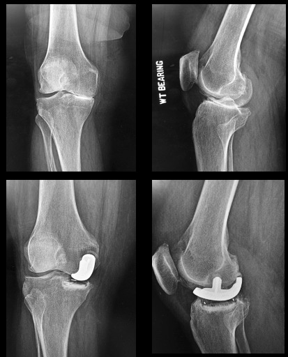 X-ray of a knee joint AI-generated content may be incorrect.