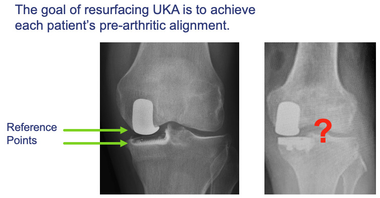 X-ray of a knee with a prosthetic knee AI-generated content may be incorrect.