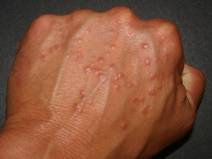 Management of a Unique Presentation of a Common Dermatologic Condition ...