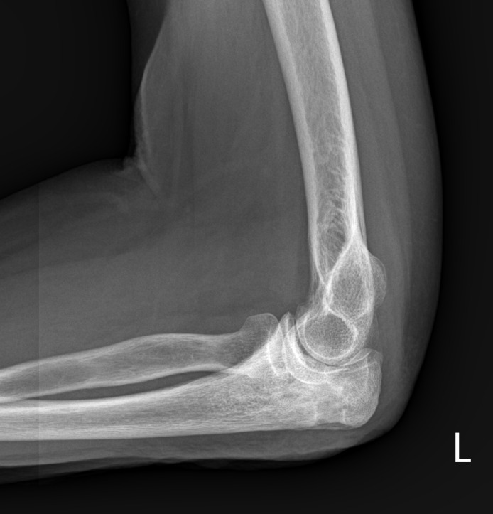 X-ray of a person's elbow Description automatically generated