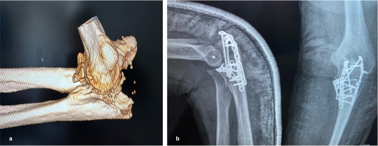 Coronoid Process Of Ulna Radiology