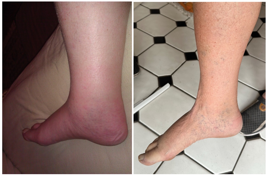 glutathione edema Side Effects: What to Know Treatment of Primary Lymphedema Following