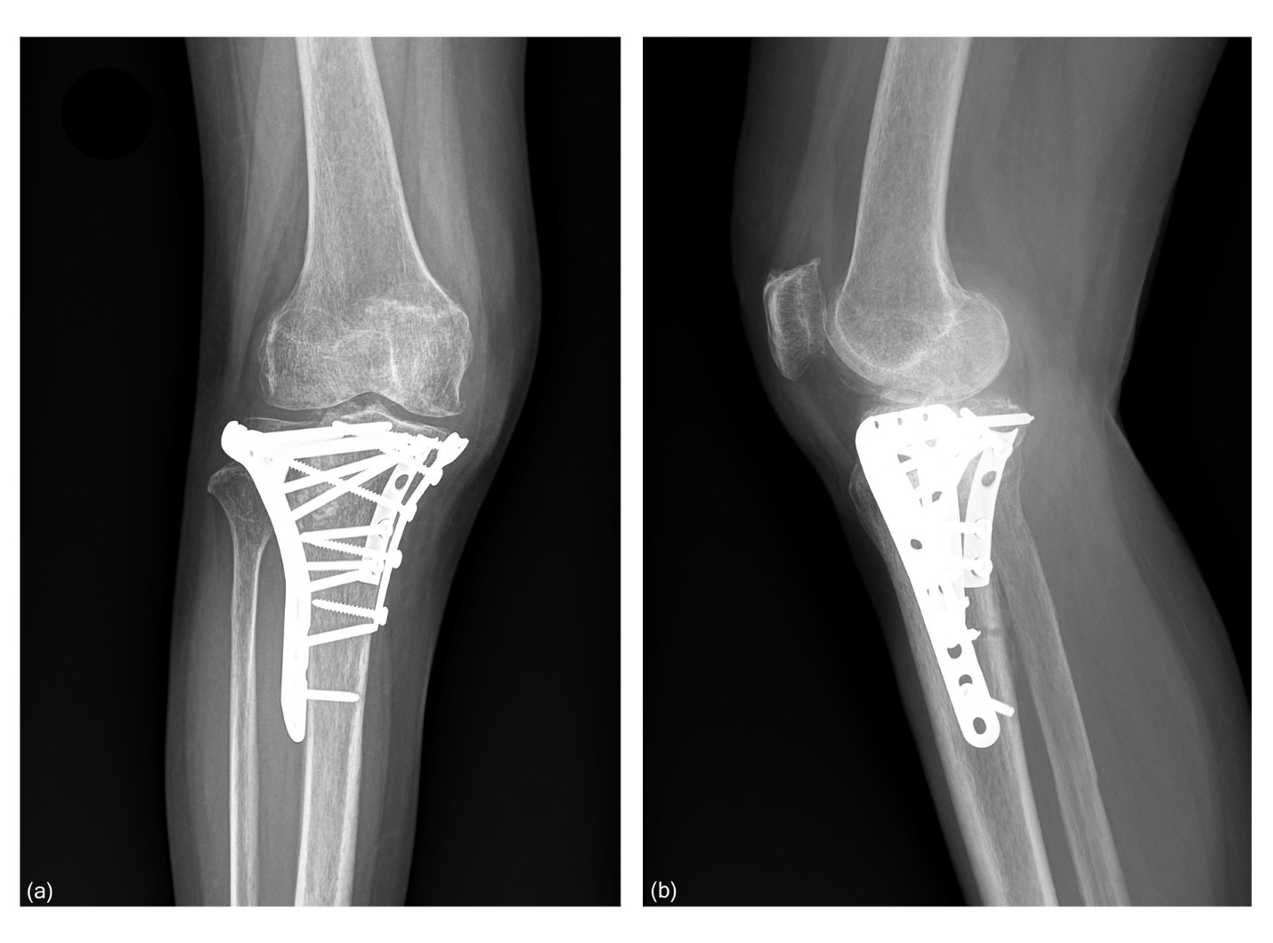 X-ray of a knee with a metal implant AI-generated content may be incorrect.