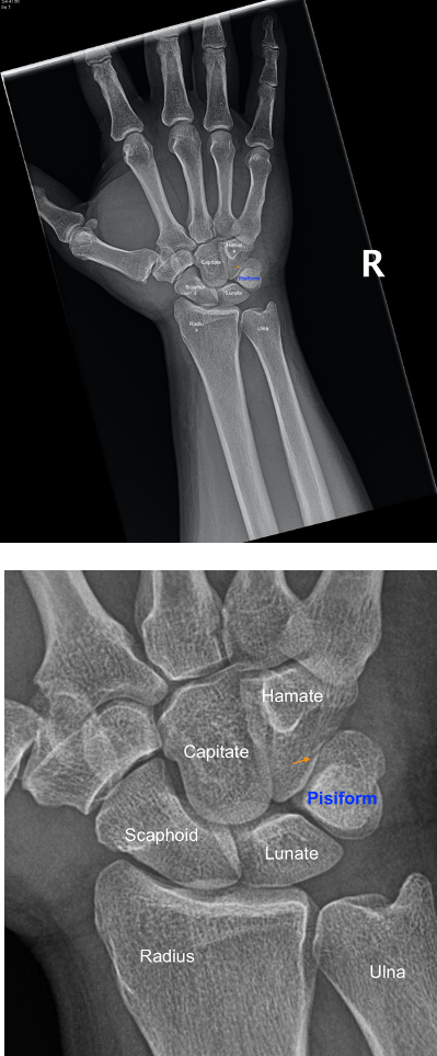Triquetral Bone Xray