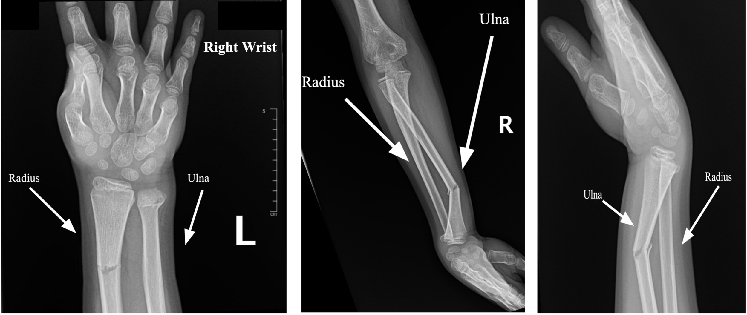 X-ray of a hand with a right wrist Description automatically generated with medium confidence