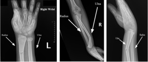 Comminuted Displaced And Angulated Distal Radial And Ulnar