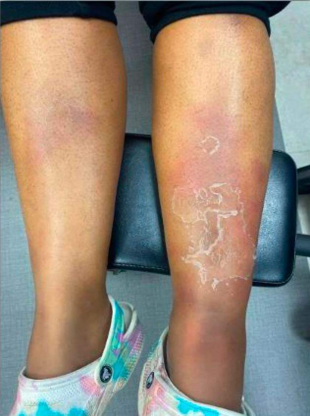 A person's legs with a rash on them Description automatically generated