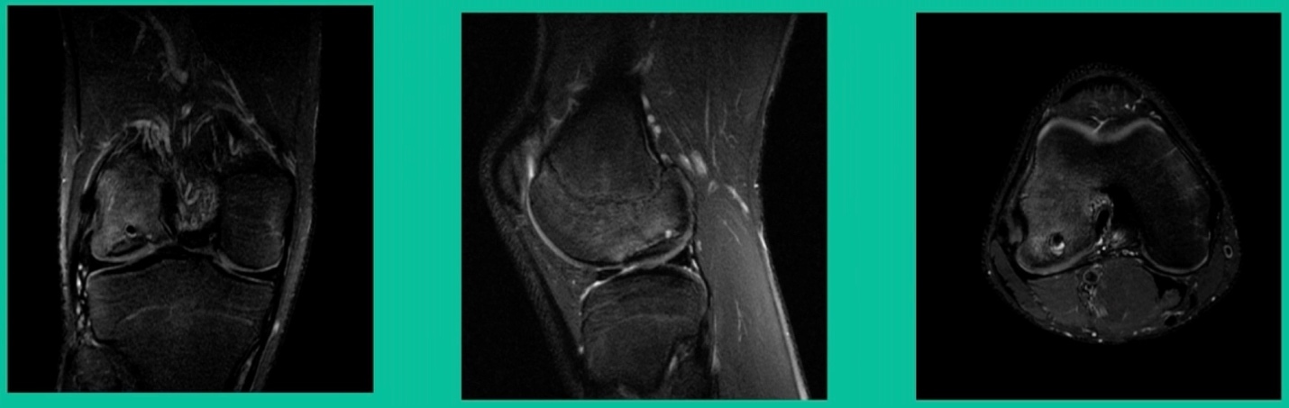 A close-up of a knee AI-generated content may be incorrect.