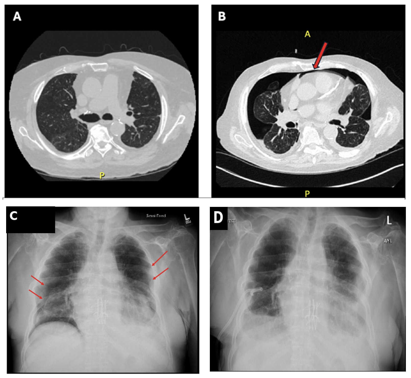 An x-ray of a person's chest Description automatically generated