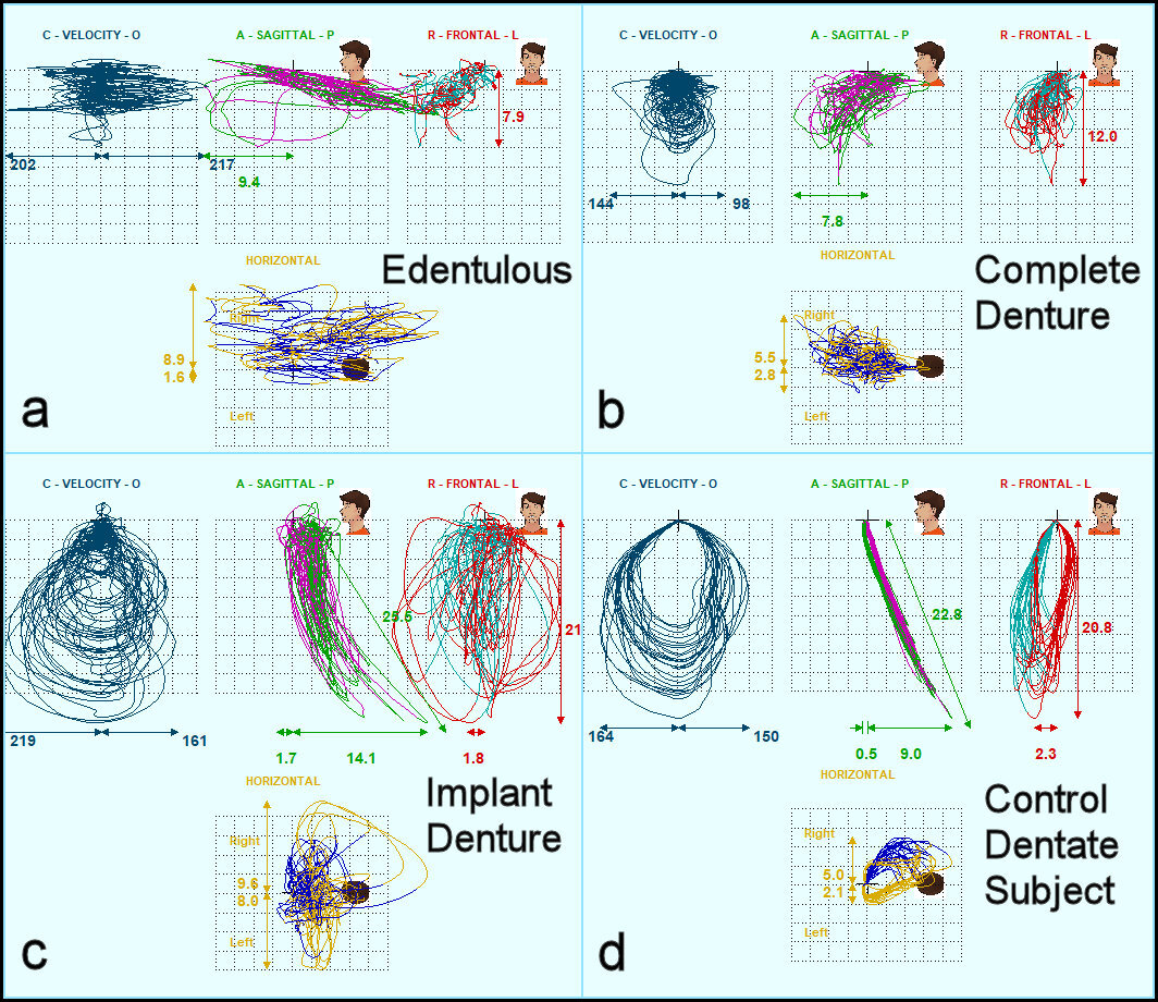 Masticatory Analysis Of An Edentulous Patient, Case Report | Published ...