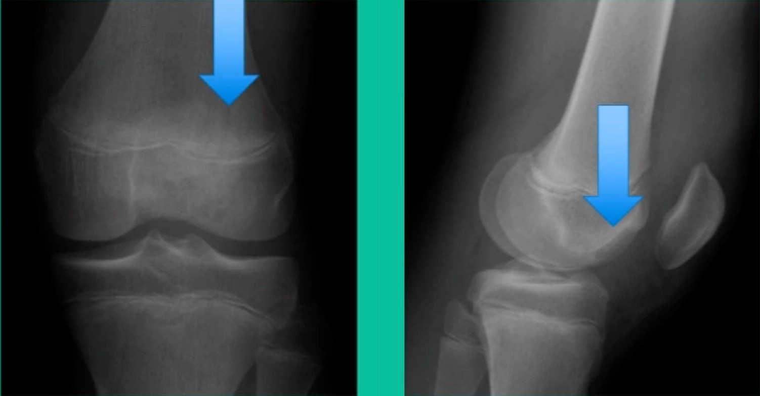 X-ray of a knee joint AI-generated content may be incorrect.