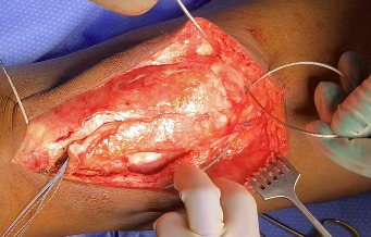 A person with a wound on their leg AI-generated content may be incorrect.