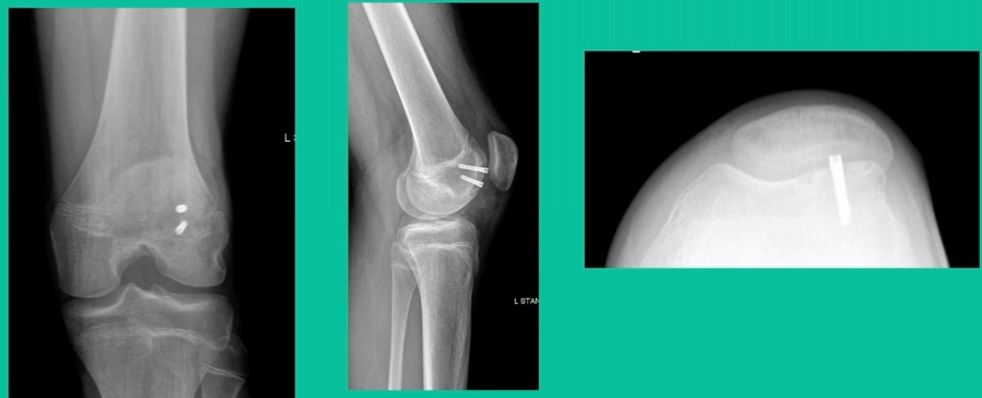 X-ray of a knee and a knee joint AI-generated content may be incorrect.