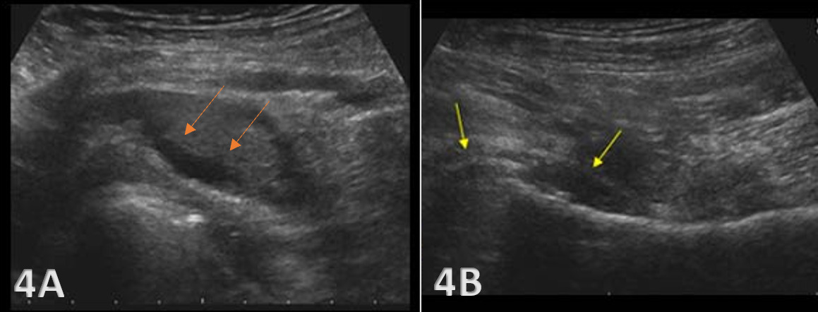 A close-up of a ultrasound Description automatically generated