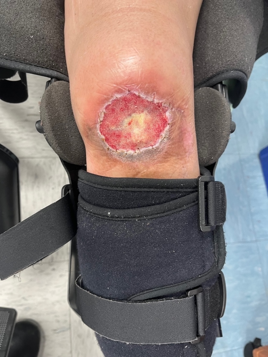 A close up of a wound Description automatically generated