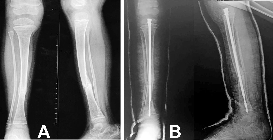 Pre-operative and post-operative x-rays of a child's tibia showing correction of valgus deformity with Fassier-Duval telescopic nail