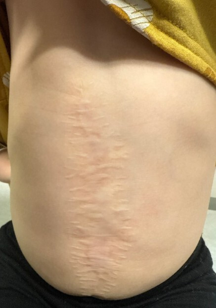 A close up of a scar Description automatically generated