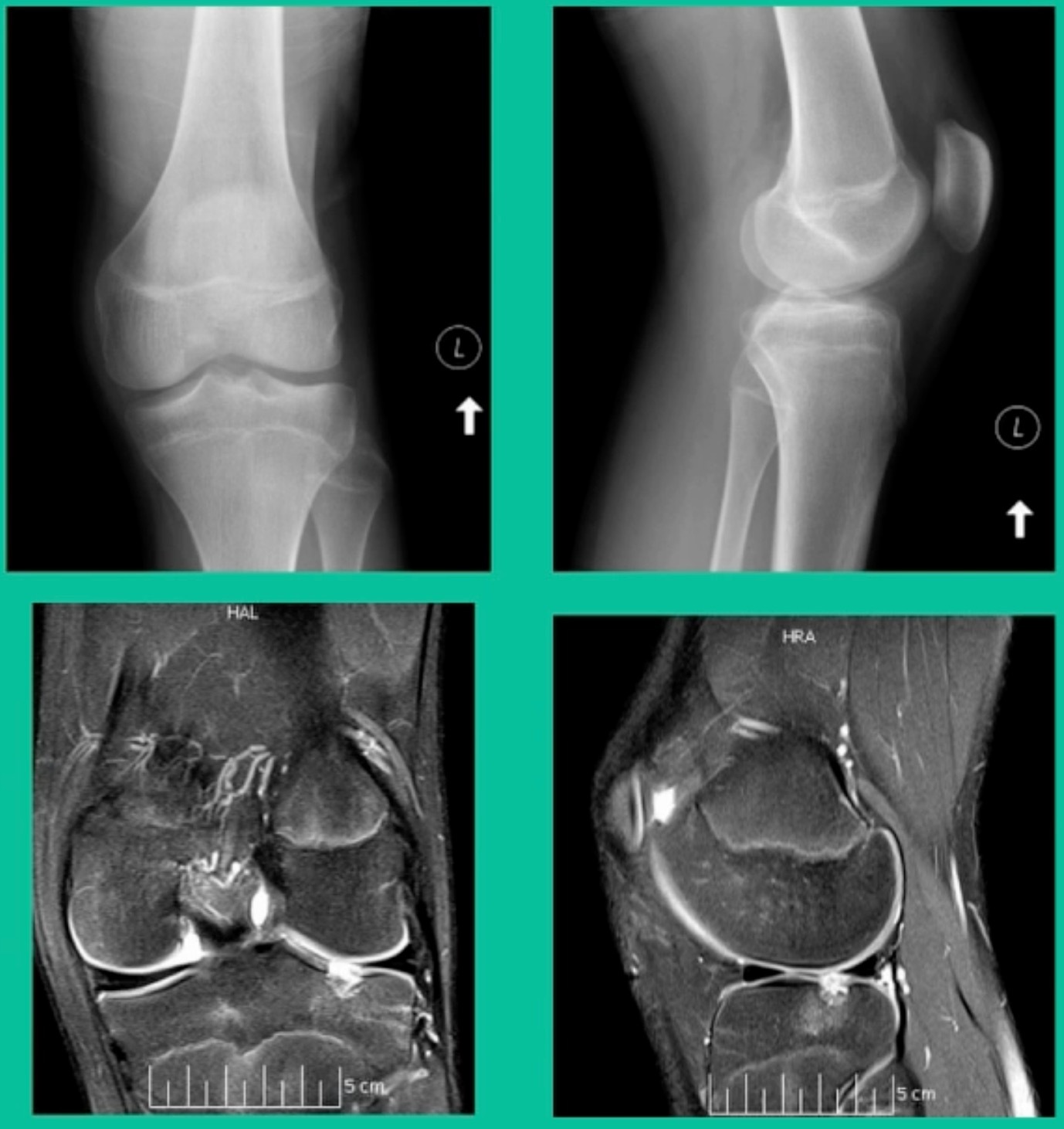 X-ray images of a knee joint AI-generated content may be incorrect.