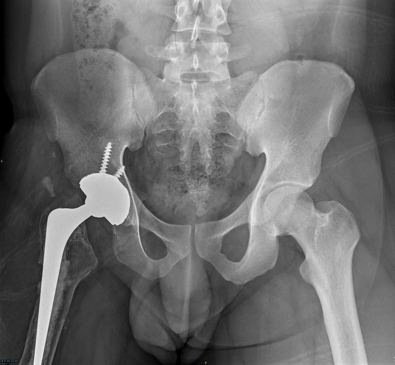 X-ray of a hip joint AI-generated content may be incorrect.