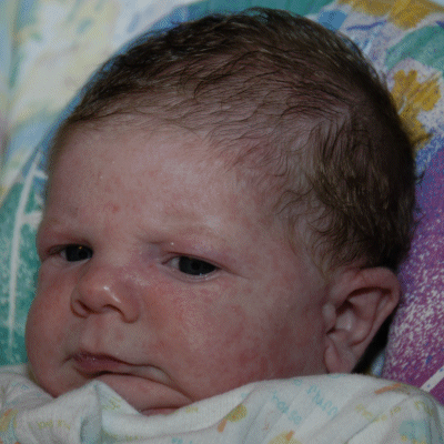Child Eczema Child Eczema