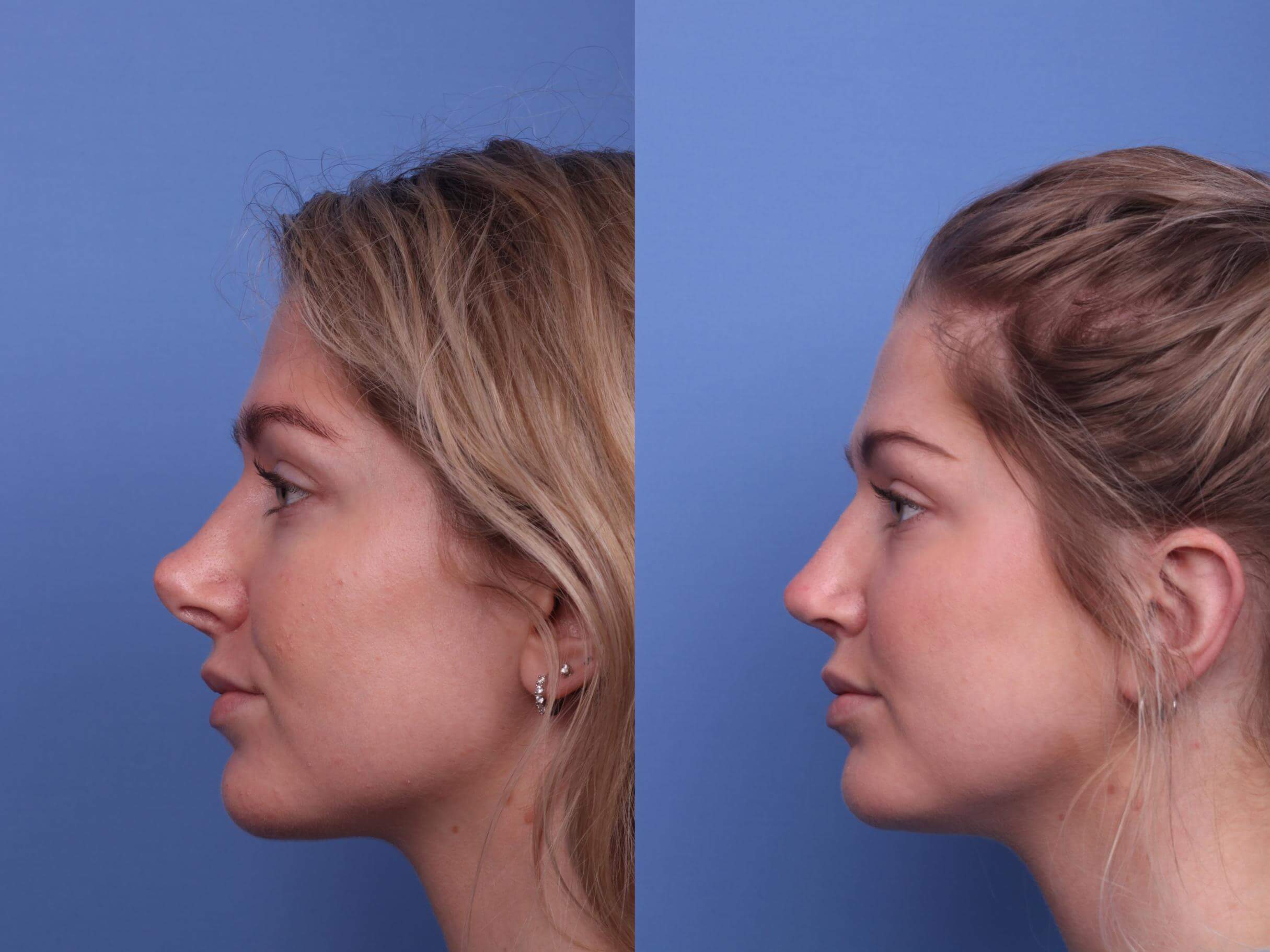 Affordable Rhinoplasty Avonsleigh