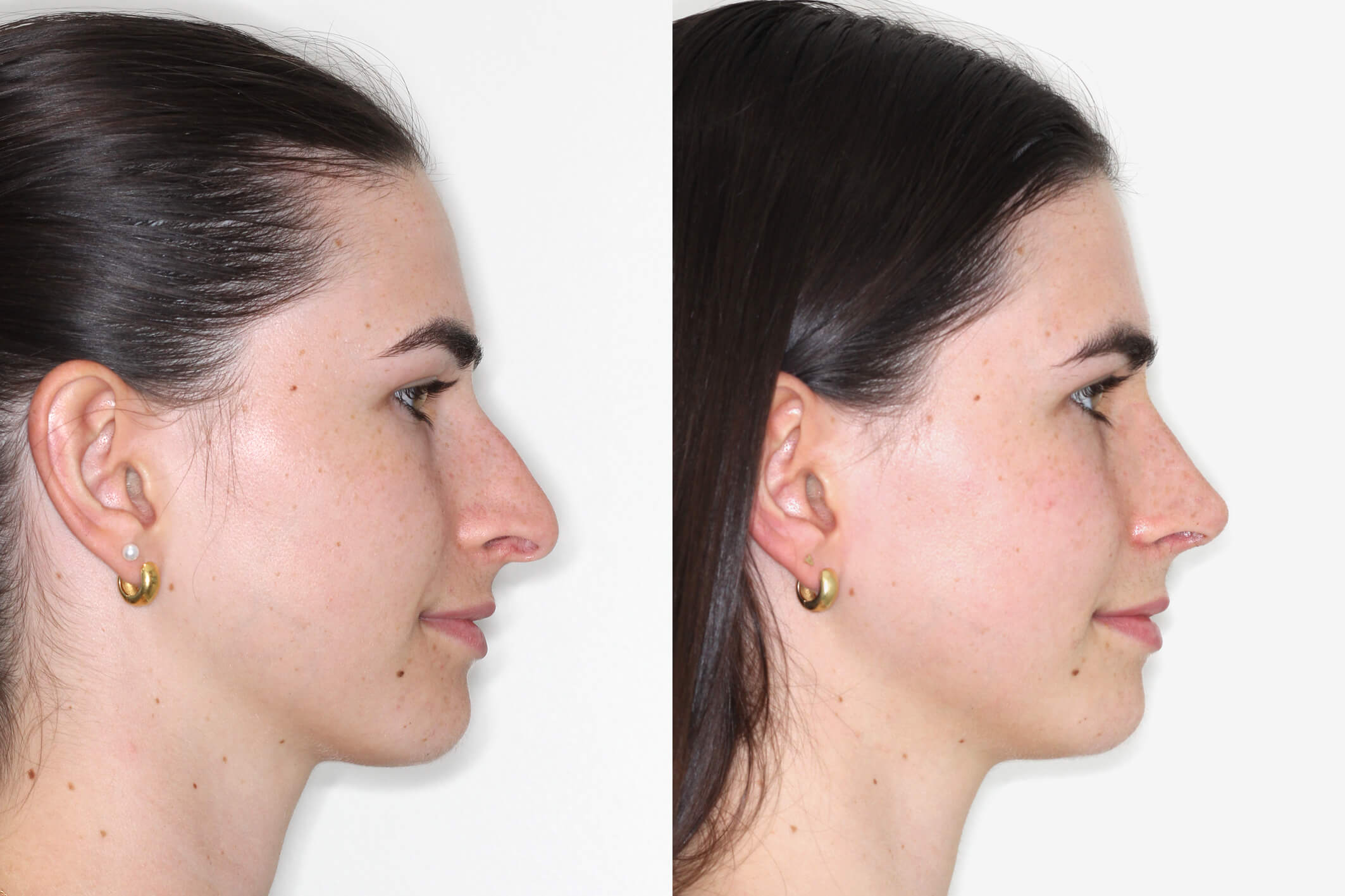  Rhinoplasty Surgery Cost Coogee