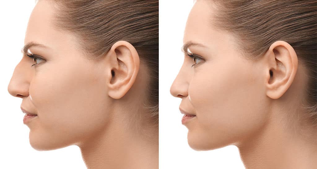 Nose Job Financing Abbotsbury