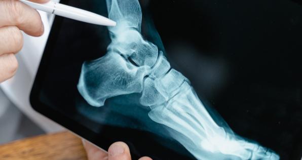 ¿Qué causa la osteoporosis y a quiénes afecta?