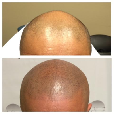 Micro Scalp Design Image