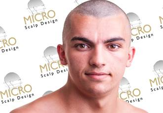 Micro Scalp Design Logo