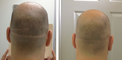 Micro Scalp Design Image